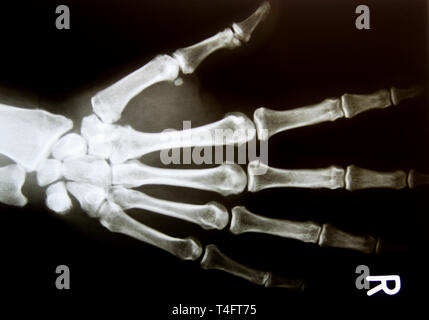 X-ray Image der gesunden normalen menschlichen Hand Stockfoto