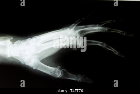 X-ray Image der gesunden normalen menschlichen Hand Stockfoto