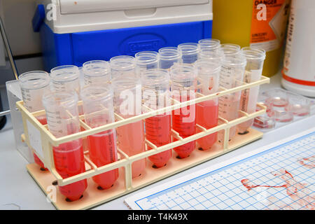 Hinweis: ANSTÖSSIGE INHALTE ALS MENSCHLICHE GEWEBE werden SEZIERT Durchstechflaschen mit menschlichen Geweben in einem medizinischen klinischen Labor an der Universität von Bristol. PRESS ASSOCIATION Foto. Bild Datum: Montag, 8. April 2019. Photo Credit: Ben Birchall Stockfoto