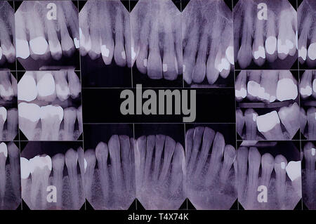 Ein X-ray der Zähne, zusammengesetzten von jedem Zahn, Kronen und Archivierungen zahnmedizinische Gesundheit zu bewerten oder Ihre Identität bestätigen. Stockfoto