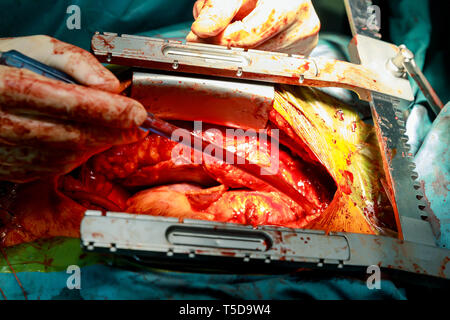 Operation am offenen Herzen naht mehr Saphenous Vein koronarer Bypass-Operation Stockfoto