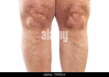 Closeup Bild der weiblichen Beinen, Krampfadern als medizinisches Problem Konzept auf weißem studio Hintergrund isoliert Stockfoto