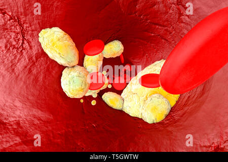 Gerenderten 3D-Illustration, Visualisierung von Fett eine Arterie verstopfen und die Bildung der Krankheit Arteriosklerose Stockfoto