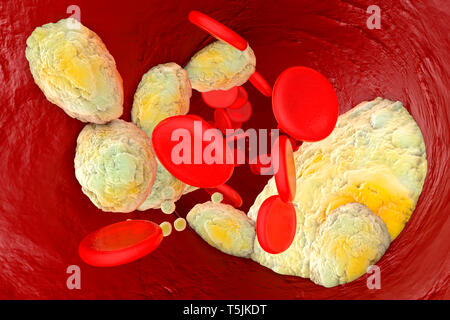 Gerenderten 3D-Illustration, Visualisierung von Fett eine Arterie verstopfen und die Bildung der Krankheit Arteriosklerose Stockfoto