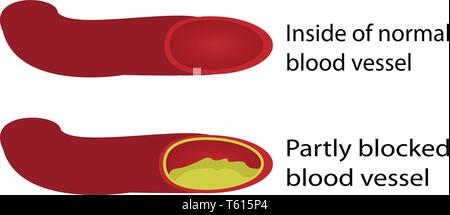 Gesunde und verstopfte Blutgefäße Abbildung Stock Vektor