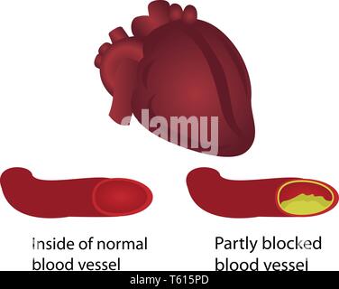 Gesunde und verstopfte Blutgefäße Abbildung Stock Vektor