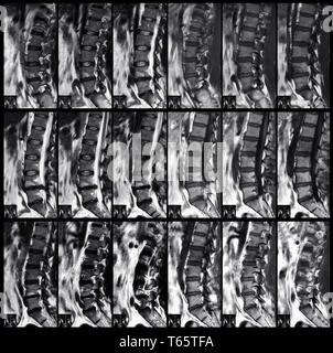 X-ray der Wirbelsäule Stockfoto