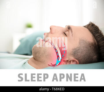 Abbildung: Atemwege während der obstruktiven Schlafapnoe Stockfoto