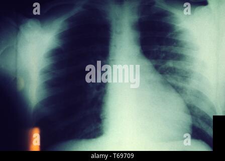 Brust Röntgenbild zeigt eine bilaterale pulmonale Infektionen durch dieses Opfer mit einer stärkeren Infektion in der linken Lunge, 1975 die Pest. Bild mit freundlicher Genehmigung Zentren für Krankheitskontrolle und Prävention (CDC)/Dr Jack Polen. () Stockfoto