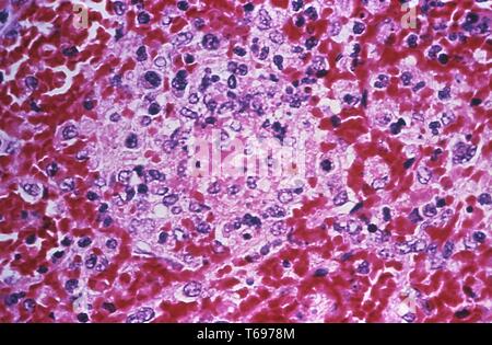 Der Photomicrograph histopathologic Veränderungen in der Milz Gewebe in einem Fall der tödlichen menschlichen Pest, 1976. Bild mit freundlicher Genehmigung von CDC/Dr. Marshall Fox. () Stockfoto