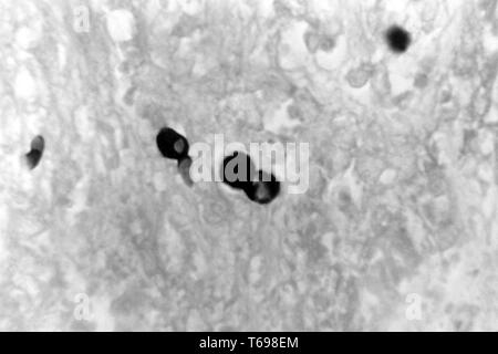 Methenamin silber Fleck photomicrograph des histopathologic Veränderungen in blastomykose durch Blastomyces dermatitidis, 1972. Bild mit freundlicher Genehmigung Zentren für Krankheitskontrolle und Prävention (CDC)/Dr William Kaplan. () Stockfoto