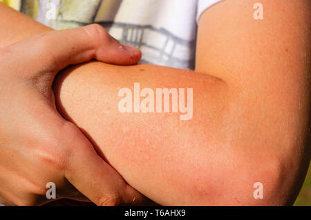 Oberer Arm Haut frische Wespenstich. Close Up. Stockfoto