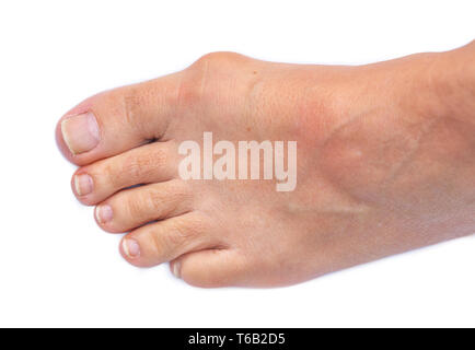 Fuß von einer Frau mit schmerzhaften Hallux Valgus Stockfoto