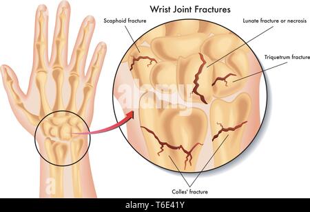 Medizinische Illustration der verschiedenen Arten von Bruch des Handgelenks Stock Vektor