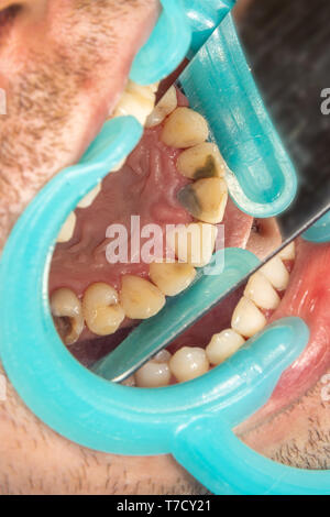 Menschliche Zähne mit Karies und Pol. Close-up Makro zahnmedizinische Klinik. Behandlung Konzept Stockfoto