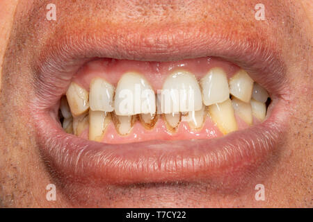 Menschliche Zähne mit Rauchen Plaque und Zahnstein. Close-up Makro zahnmedizinische Klinik. Hygiene Konzept Stockfoto