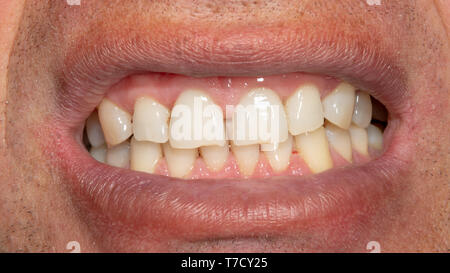 Menschliche Zähne mit Rauchen Plaque und Zahnstein. Close-up Makro zahnmedizinische Klinik. Hygiene Konzept Stockfoto