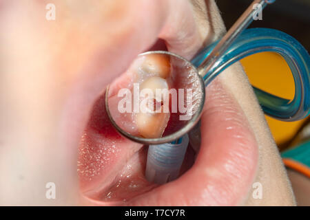 Menschliche Zähne mit Karies und Pol. Close-up Makro zahnmedizinische Klinik. Behandlung Konzept Stockfoto
