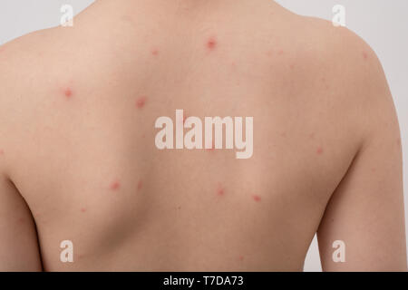 Nahaufnahme von der Rückseite des Jungen mit Varicella-zoster Virus oder Windpocken. Bubble Hautausschlag auf Kind. Dermatologie Begriff. Stockfoto