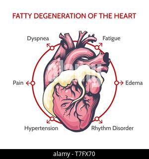 Verfettung des Herzens. Die wichtigsten Symptome der Krankheit. Medizin Kardiologie Vector Illustration. Stock Vektor