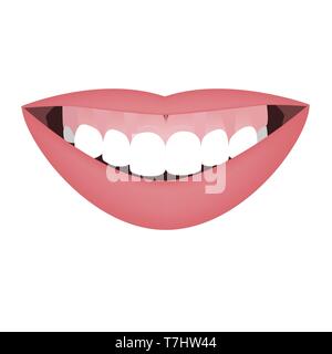 Mund mit einem distalen Beißen und hohe Lächeln oder gummiartiges Lächeln vor dem orthotropics orthotropics oder Behandlung. Vector Illustration Stock Vektor