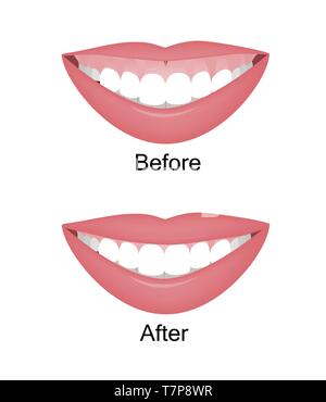 Mund mit einem hohen Lächeln oder gummiartiges Lächeln vor und nach dem orthotropics, orthotropics oder Botox Injektionen Korrektur. Vector Illustration. Stock Vektor