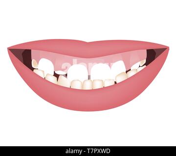 Kinder Mund mit einem zu groß Unterkiefer und hohe Lächeln oder gummiartiges Lächeln vor dem orthotropics orthotropics oder Behandlung. Unterbiss Bisses Stock Vektor