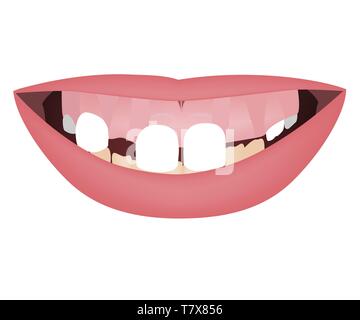 Kinder backen mit gummy Smile, gekrümmte Unterkiefer und distalen Biss vor dem orthotropics orthotropics oder Behandlung. Vector Illustration Stock Vektor