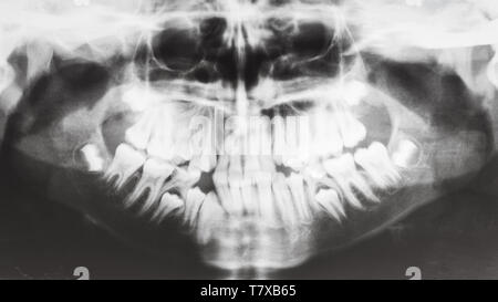 Vorderansicht des menschlichen Kiefer auf X-ray Image Stockfoto
