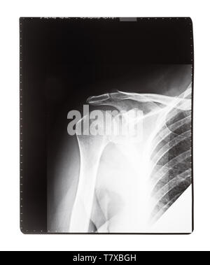 Film mit X-ray Bild von vorne Blick auf menschliche Schultergelenk auf weißem Hintergrund Stockfoto