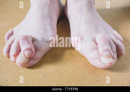 Valgus Deformität der weiblichen Bein wegen Hallux Valgus und Schwäche der Bänder. Stockfoto