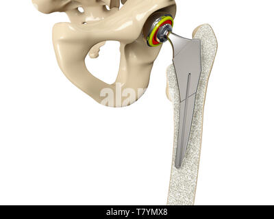 3D-Darstellung der Hüftoperation Implantat im Becken Knochen installiert. Stockfoto