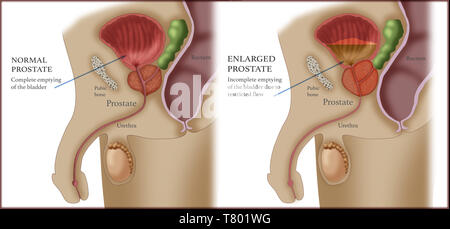 Vergleich der Normalen und der vergrößerten Prostata Stockfoto