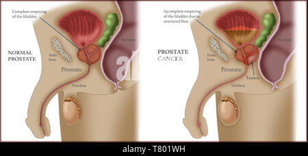 Vergleich der normalen Prostata, Prostatakrebs, Abbildung Stockfoto