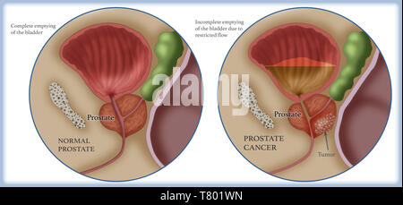 Prostatakrebs, Abbildung Stockfoto