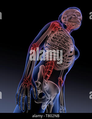 Arthritis, Abbildung Stockfoto