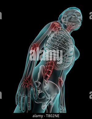 Arthritis, Abbildung Stockfoto