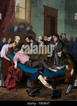 Anästhesie, 1846 Stockfoto