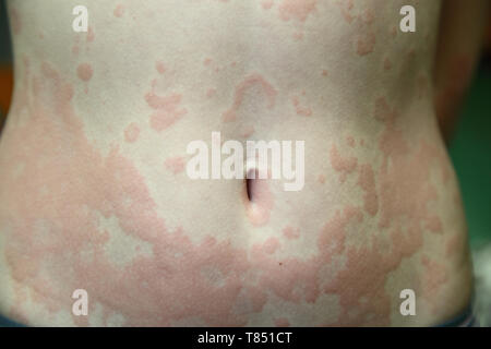 Allergische Dermatitis. Die Haut der Mädchen ist von Dermatitis erstaunt Stockfoto