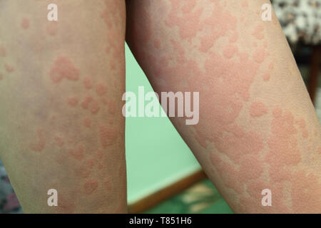 Allergische Dermatitis. Die Haut der Beine der Mädchen wird von Dermatitis erstaunt Stockfoto