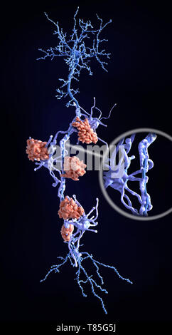 Nervenschäden bei multipler Sklerose, Abbildung Stockfoto