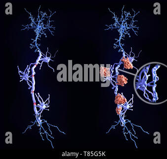 Gesunden Neuronen und Nervenschäden bei multipler Sklerose Stockfoto