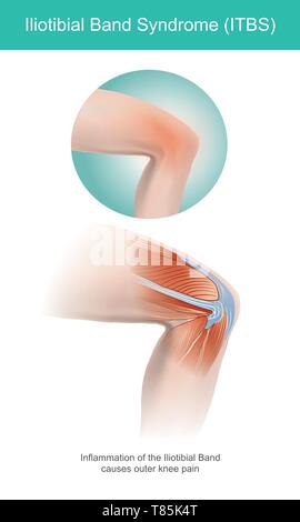 Die Iliotibial Band ist eine Längs faserige Verstärkung der Fascia lata in einem Knie Muskel. Teil der Anatomie des menschlichen Körpers. Abbildung. Stock Vektor