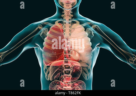 Red hepatisation der Lobar pneumonia, konzeptionelle Darstellung Stockfoto