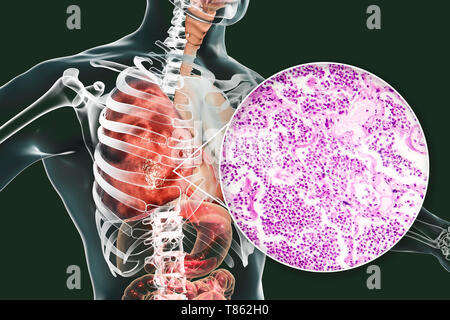 Lobar pneumonia, Illustration und leichte Schliffbild Stockfoto