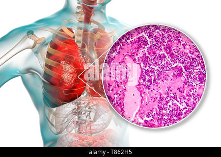 Lobar pneumonia, Illustration und leichte Schliffbild Stockfoto