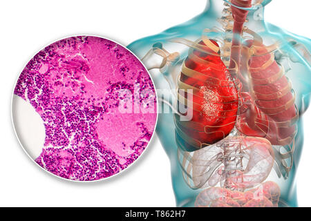 Lobar pneumonia, Illustration und leichte Schliffbild Stockfoto