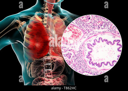 Lobar pneumonia, Illustration und leichte Schliffbild Stockfoto