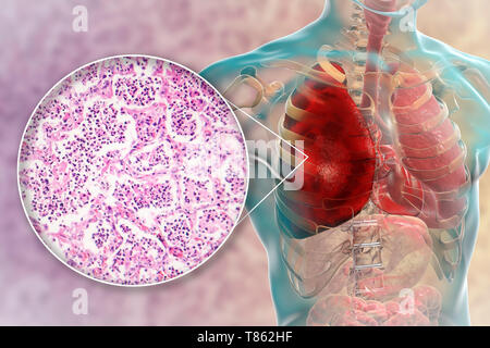 Lobar pneumonia, Illustration und leichte Schliffbild Stockfoto