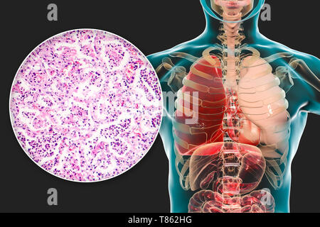 Lobar pneumonia, Illustration und leichte Schliffbild Stockfoto